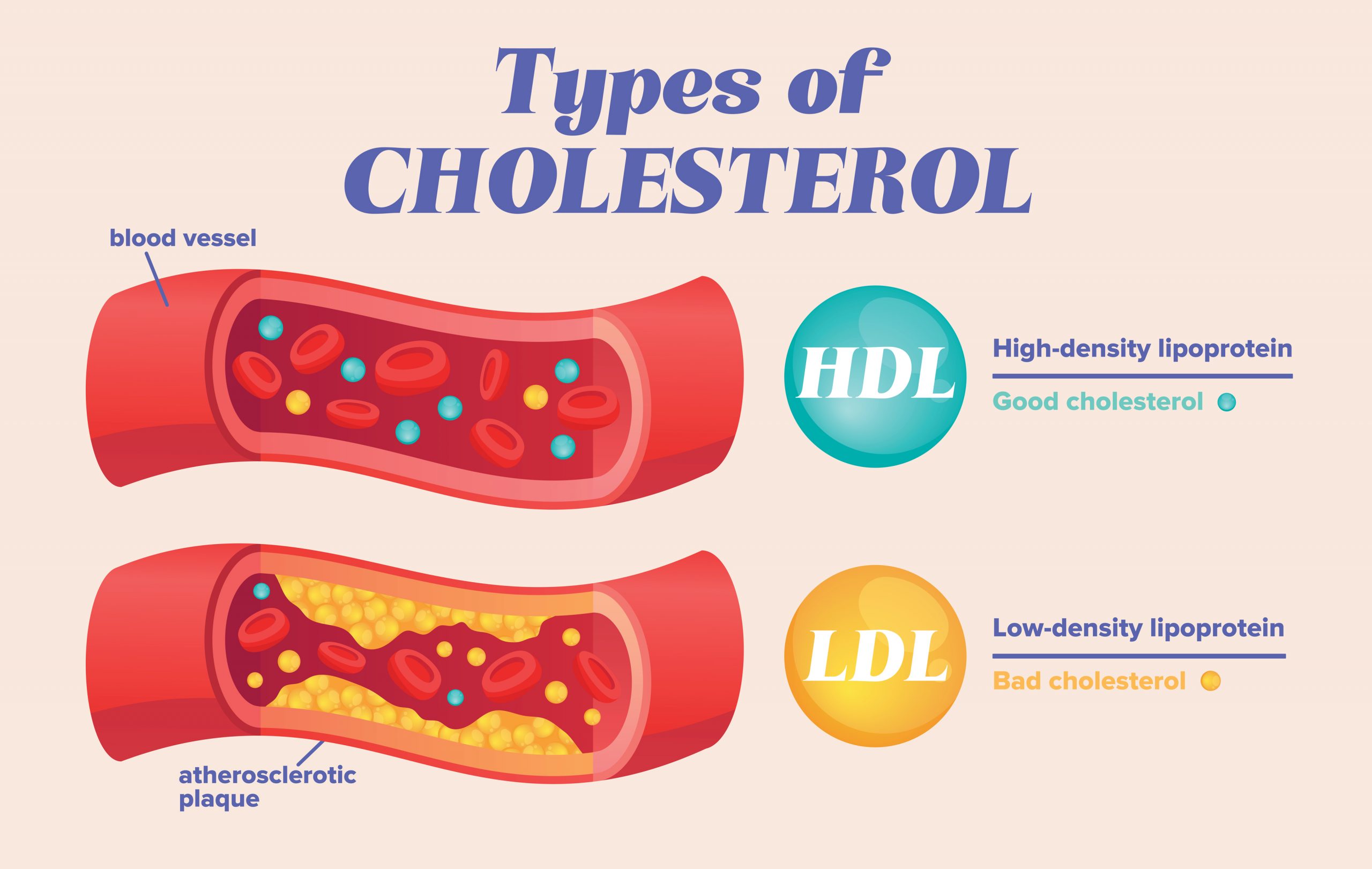 Cholesterol and Alzheimer's