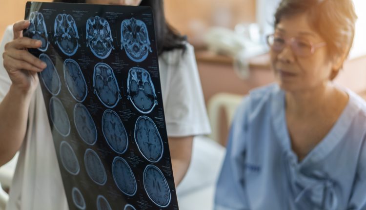 early diagnose dementia, early diagnose Alzheimer's