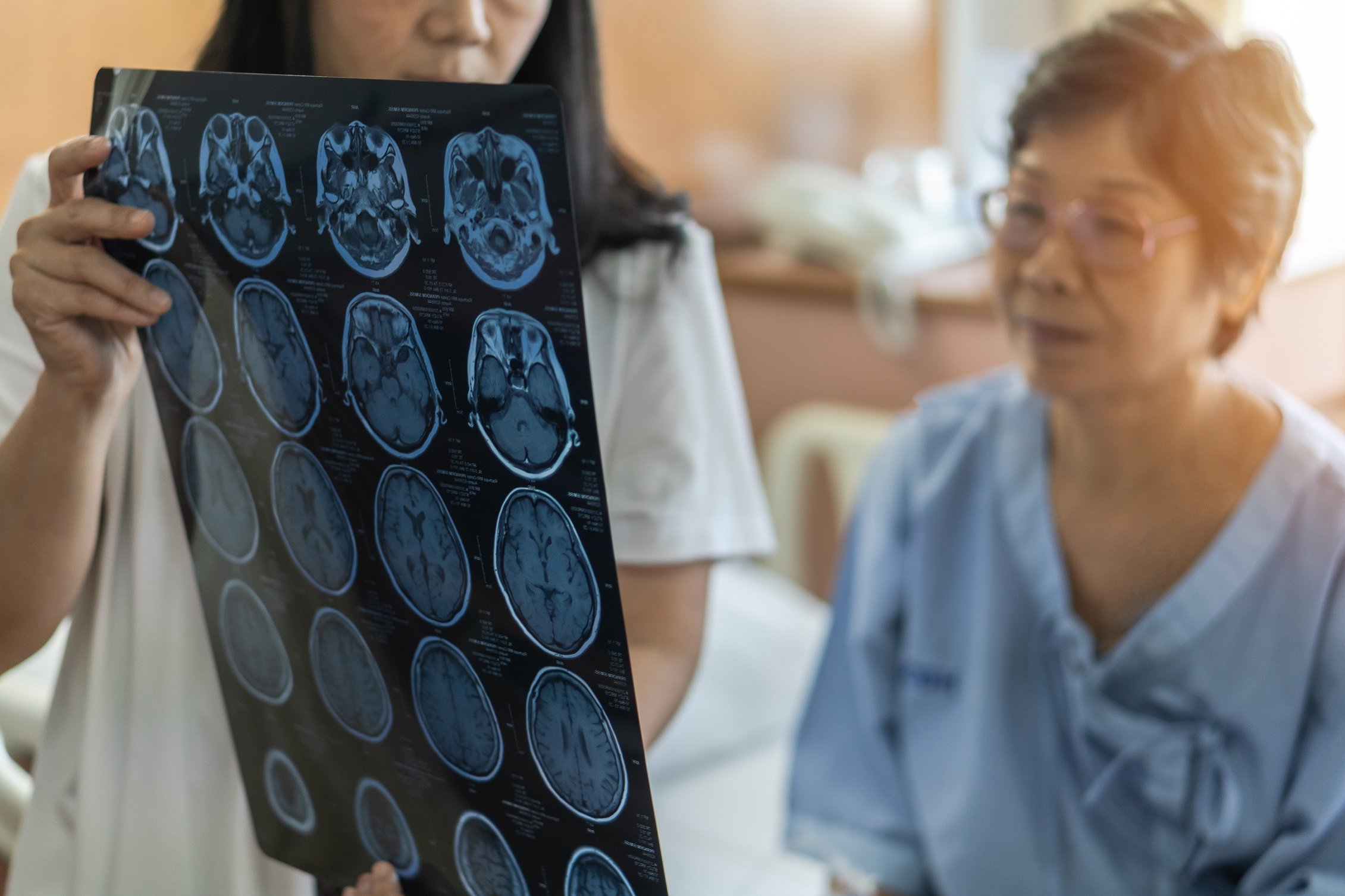 early diagnose dementia, early diagnose Alzheimer's