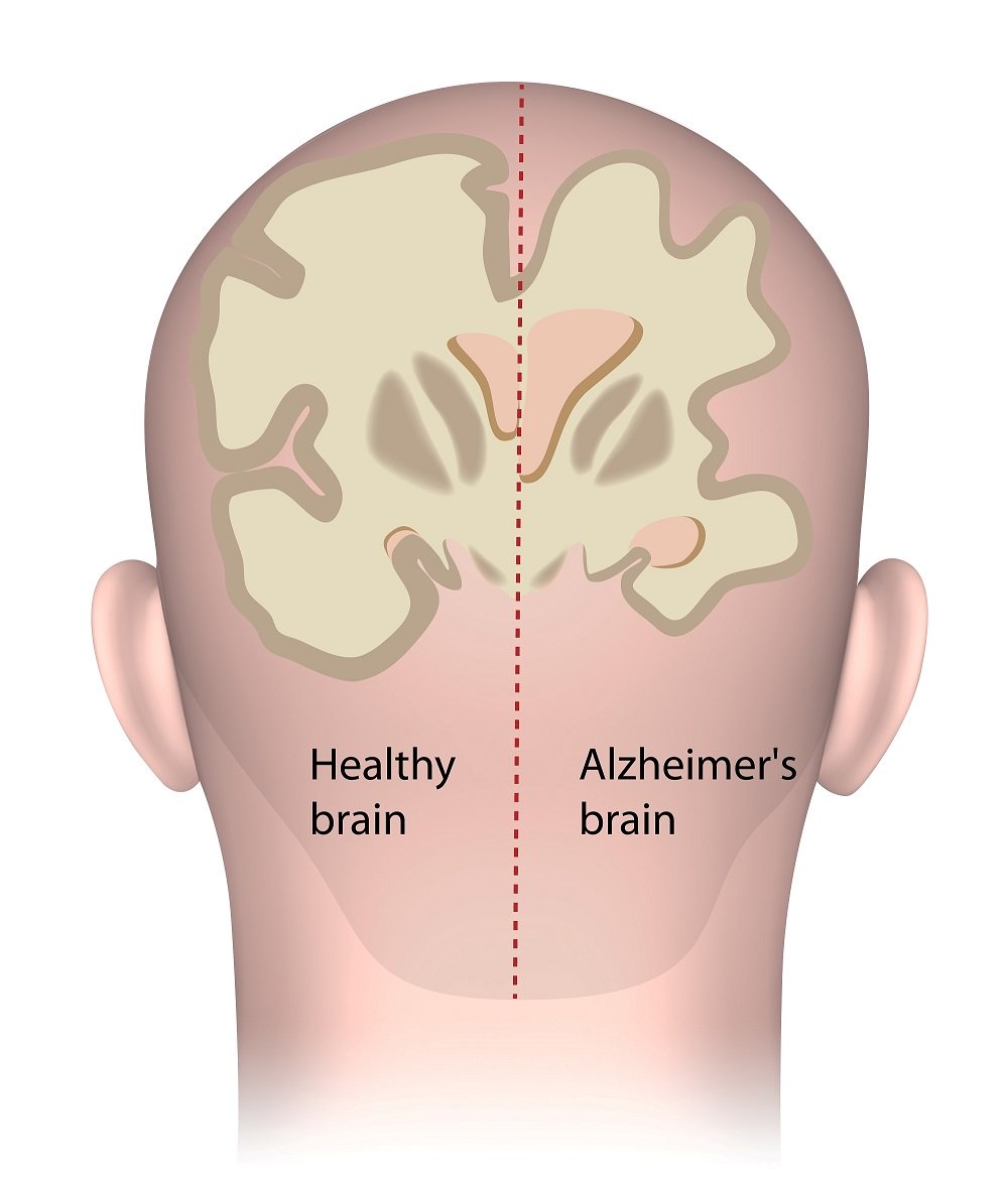 What Part of the Brain Is Affected by Alzheimer's