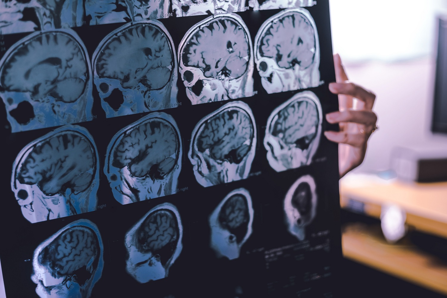 frontal lobe atrophy on MRI film, Frontotemporal dementia diagnosis