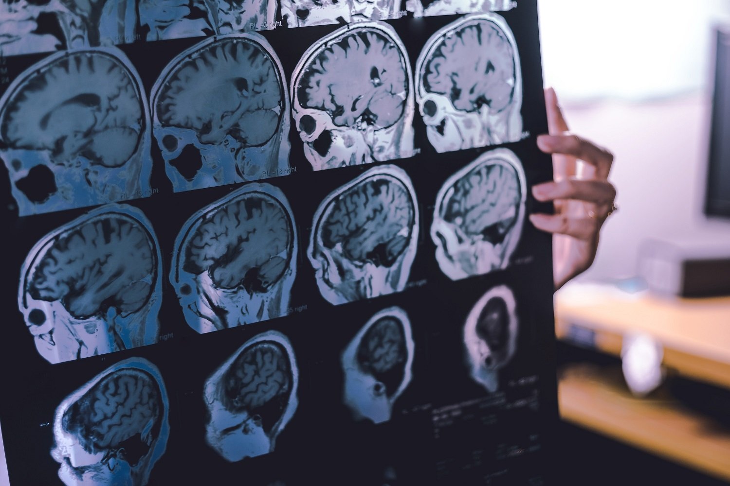 frontal lobe atrophy on MRI film, Frontotemporal dementia diagnosis