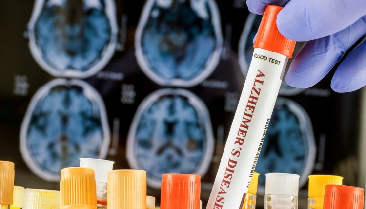 Scientist,Holds,Blood,Sample,To,Investigate,Remedy,Against,Alzheimer's,Disease,